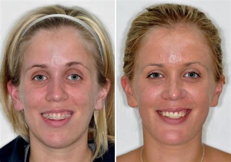 Case 5 Upper And Lower Jaw Surgery Sydney Oral And Facial Surgery