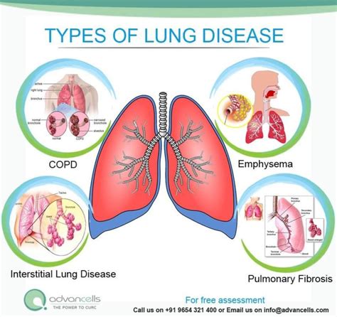 Is Chronic Lung Disease Curable With Stem Cell Therapy Advancells