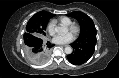 Axial Ct Scan With Contrast Of The Lower Thorax On Re Admissionthe
