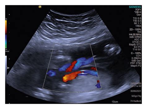 Ultrasound Anomaly Scan Of A Fetus At 21 Weeks And Six Days Of