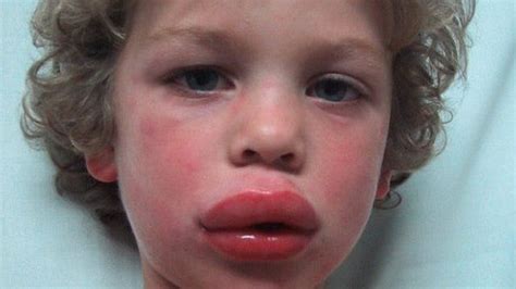 Severe Allergic Reactions Allergy Treatment Anaphylaxis