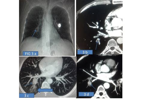 A Ct Scanogram Showing Right Infrahilar Opacity Arrow Suggesting