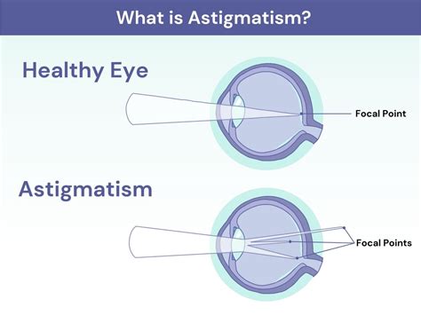 What Is Astigmatism ®