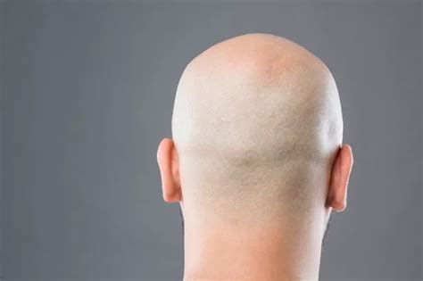 Baldness Breakthrough To Stimulate Hair Growth As New Treatment Found