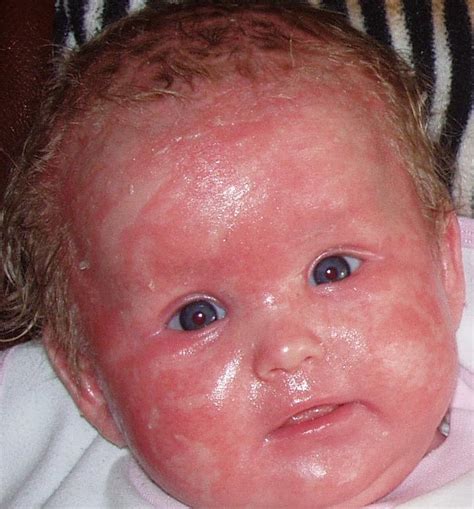 Ichthyosis Harlequin Treatment Symptoms Diagnoses Pictures
