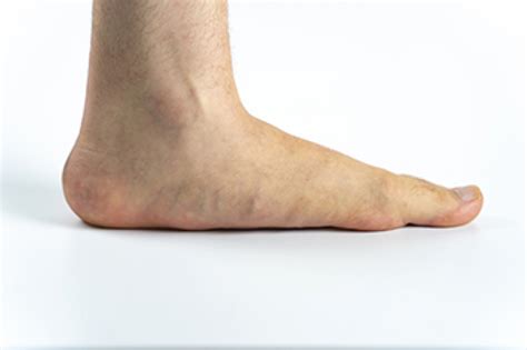 Do I Need To See A Podiatrist For Flat Feet