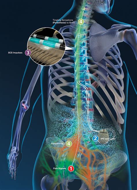 For the scs's domain, all data, the logic to process that data and all code to an scs can fulfill its primary use cases on its own, without having to rely on. About Spinal Cord Stimulation - Boston Scientific