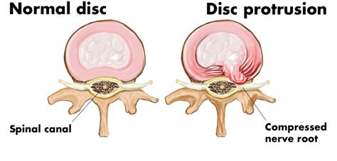L5 S1 Disc Protrusion—causes And Treatment Of Back Pain Caused By A