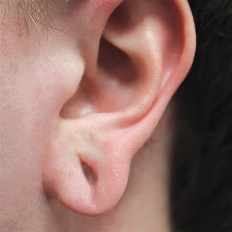 Can Earlobe Reconstruction Help Improve Peoples Career Chances Skin