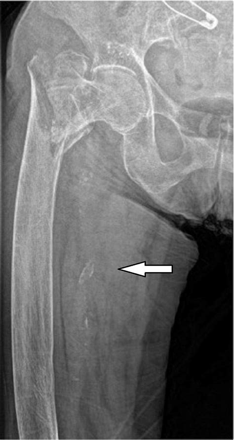 Cureus Does Presence Of Femoral Arterial Calcification Have An Effect