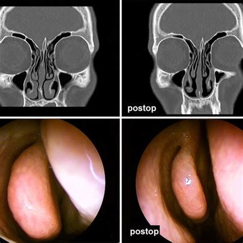 Concha Bullosa Małżowiny Nosowej środkowej - Bulbous type concha bullosa: preoperative and postoperative CT and