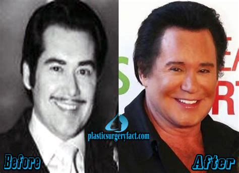 Wayne Newton Facelift Before and After - Plastic Surgery Facts