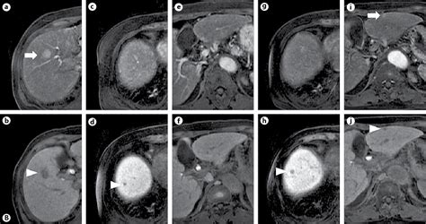 Figure 1 From Non Hypervascular Hypointense Hepatic Nodules During The