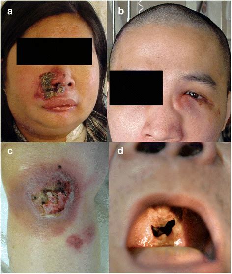 Type comprises 20% of all cutaneous lymphomas. Clinical features of NK/T-cell lymphomas. a Nasal lesion ...