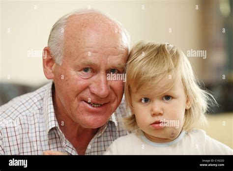 Grandpa Small Girl With A Hemangioma Stock Photo Alamy