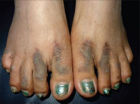 Hyperkeratotic Lesions Foot