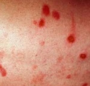See commenter at top with hyperlink to pic. Small Red Spots on Skin, not, Itchy, Tiny, Dots, Bumps ...