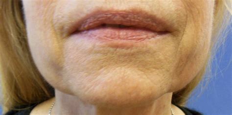 Jowls What Causes Them And How To Get Rid Of Them Non Surgically