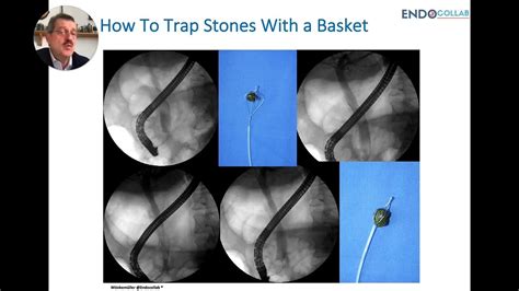Ercp Essential Tips For Bile Duct Stone Extraction Using Basket Part