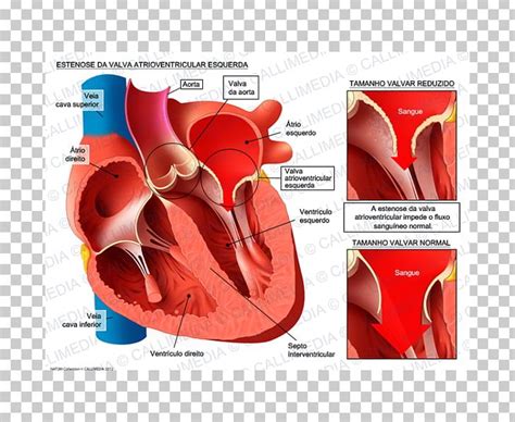 Aortic Insufficiency Aorta Aortic Stenosis Ventricle Aortic Valve PNG Clipart D Head Aorta