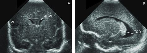 Third Ventricle Fetal Ultrasound