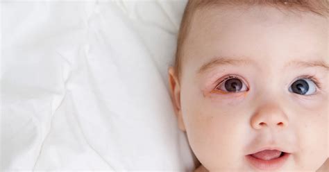 Pink Eye In Babies A Complete Guide