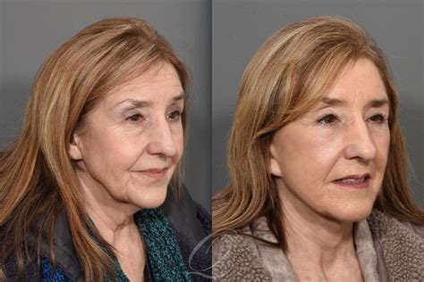 Facelift Before After Photos Patient Serving Rochester