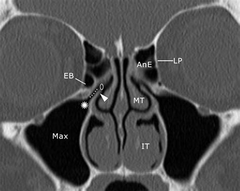 Multiplanar Sinus Ct A Systematic Approach To Imaging Before