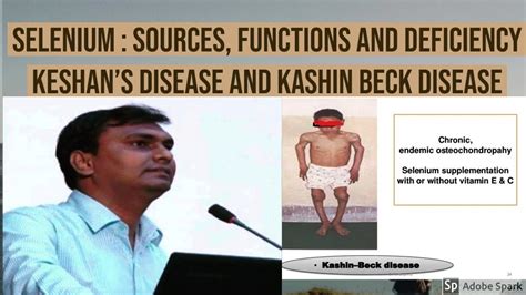 Selenuim Sources Functions And Deficiency Keshans Disease And Kashin
