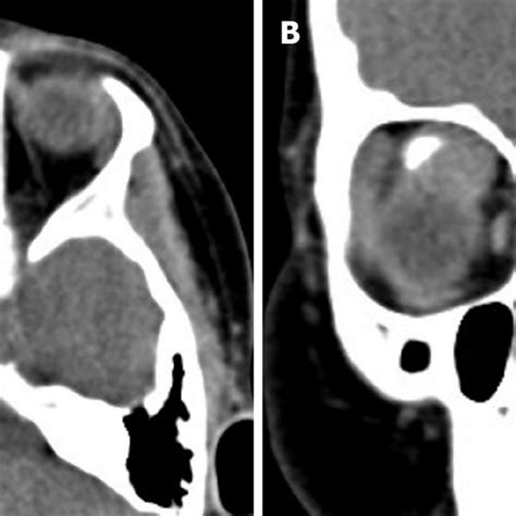 Orbital Computed Tomography Scan Showed A Well Defined Soft Tissue