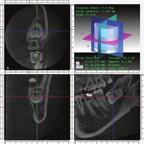 Cone Beam Computed Tomography Cbct Image Of Axial View Paraxial
