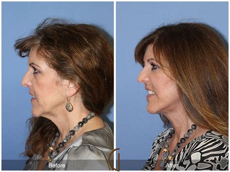 Facelift Fifties Before And After Photos Patient 69 Dr Kevin Sadati