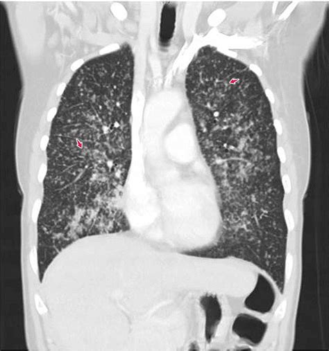 Cureus Adenocarcinoma Of The Lung Presenting With Intrapulmonary