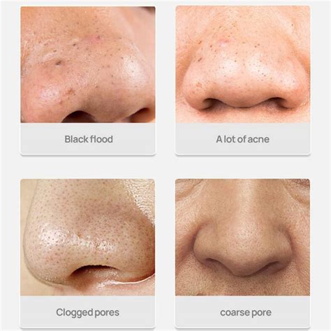 Severe Blackheads On Nose