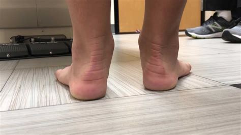 HyProCure - Solution for Children's Misaligned or Flat Feet