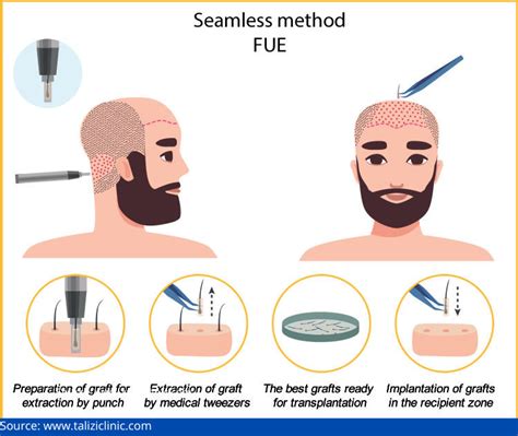 How Effective Are Various Hair Transplant Techniques