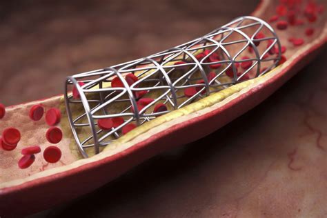 The Problem With Using Stents