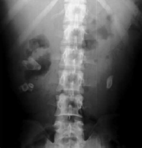 Figure 1management Of Nephrolithiasis In Autosomal Dominant Polycystic