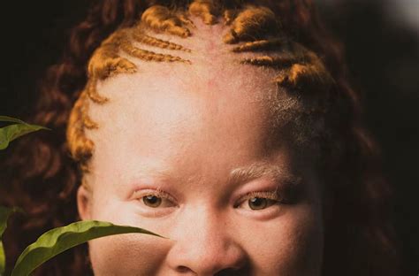 Understanding Albinism All You Ought To Know Canda Pharmacy
