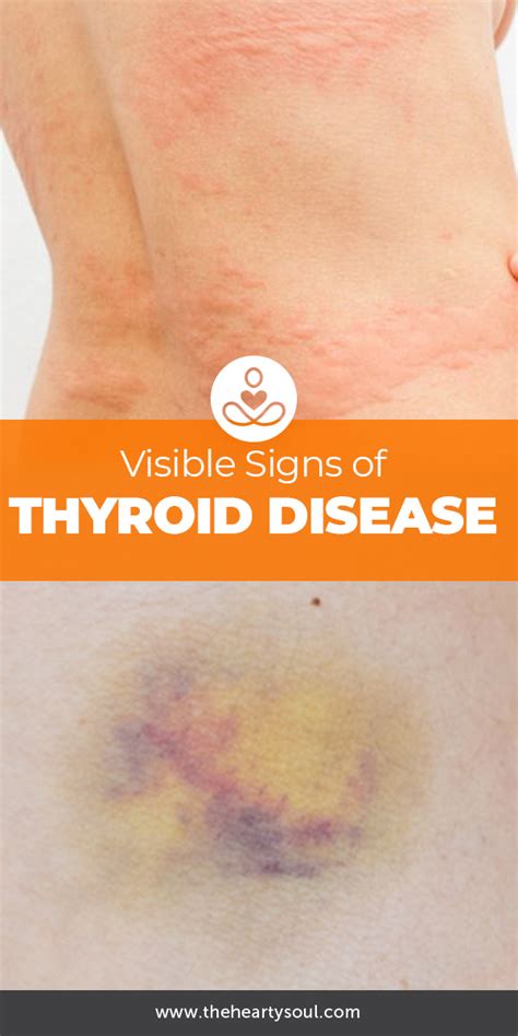 Skin Signs Of Thyroid Disease With Images Thyroid Disease Thyroid