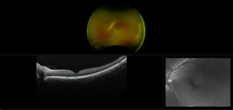 Lattice Degeneration Case Study