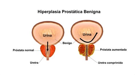 Hiperplasia ejemplos