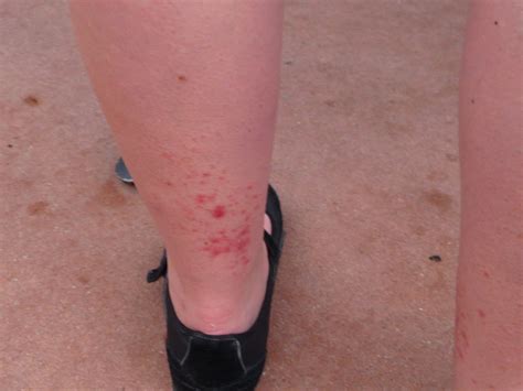 Red Spot On Legs