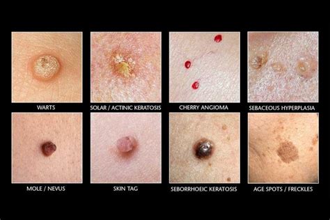 Diathermy Skin Tag Spot And Milia Removal Integrity Paramedical Skin