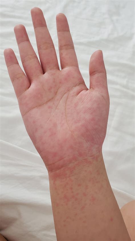 Red Raised Itchy Bumps On Skin