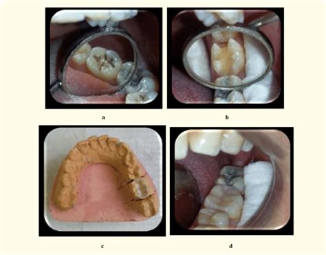 Steps Of Cavity Preparation And Restoration A Pre Operative Tooth B