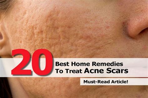 20 Best Home Remedies To Treat Acne Scars