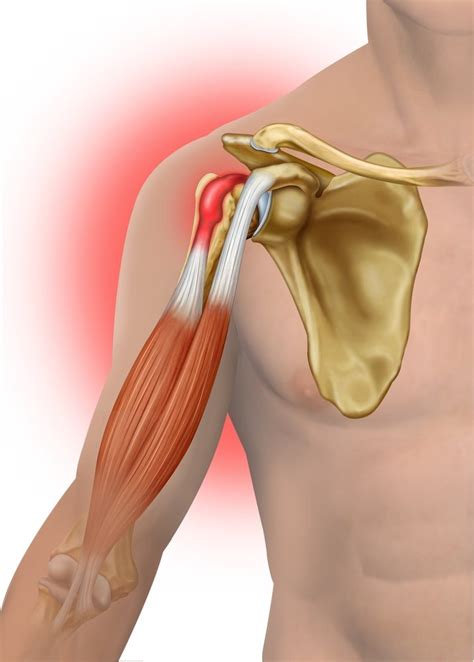 The nice stretch you feel in your biceps when doing incline. Biceps Tendinitis: Causes and Risk Factors