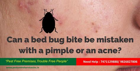 Can Bed Bug Bites Be Mistaken For Acne Whadoq