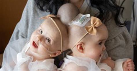 Conjoined Twins Separated After 24 Hour Surgery In California